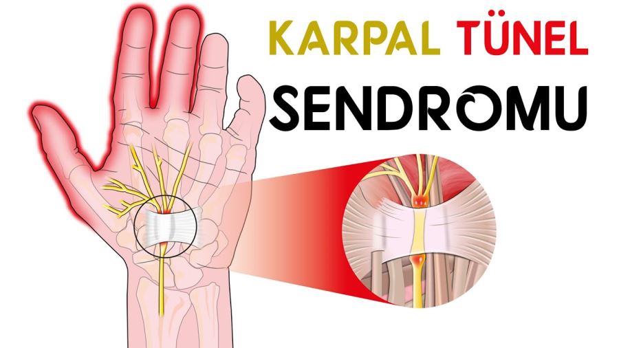 Eliyle iş yapanların hastalığı: Karpal Tünel Sendromu 