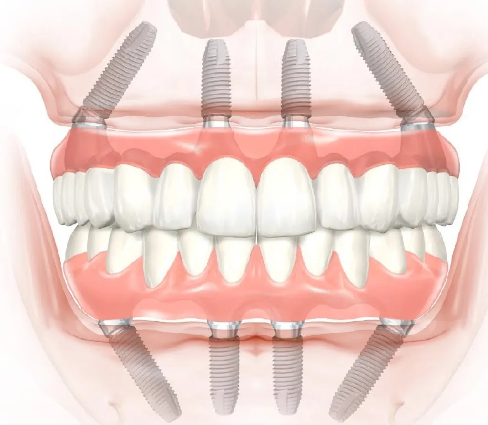 Üst çenedeki kemik yetersizliklerinde zigomatik implant çözüm olabilir! 